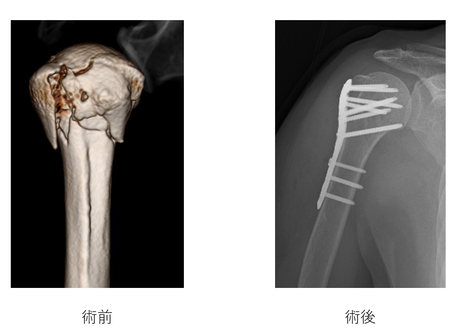 上腕骨近位部骨折