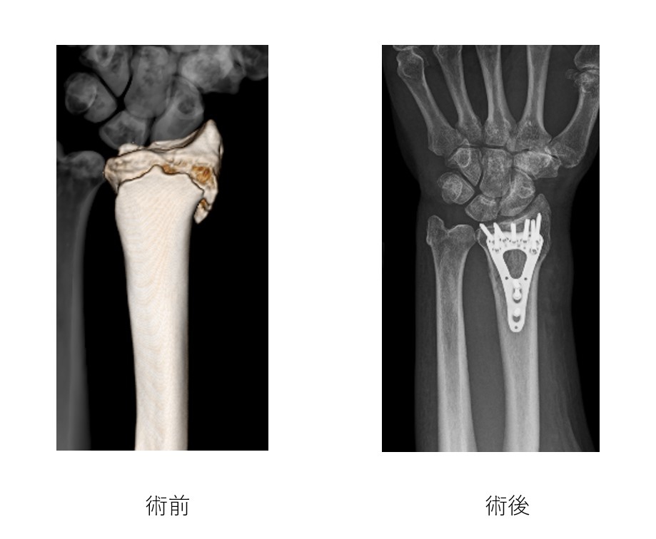 橈骨遠位端骨折