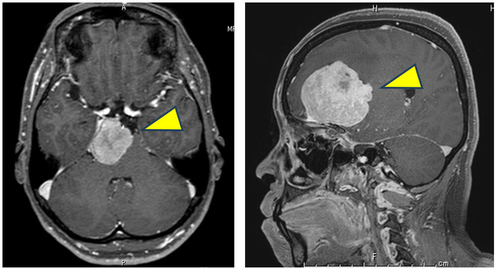 脳腫瘍（黄色の矢頭）のMRI画像