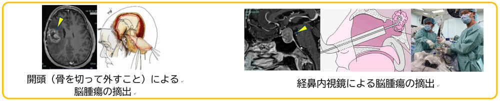脳腫瘍の摘出
