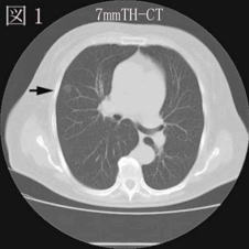 肺癌の症例【図1】